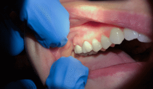 What is a Tooth Abscess?