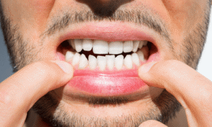 Contouring and Reshaping Teeth
