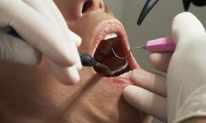 What to Expect During a Dental Sealant Procedure