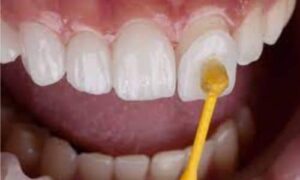 In this article, we will discuss the benefits of veneers and what they can do for your smile. Veneers are thin, custom-made shells ...