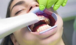 Braces, Invisalign, or Clear Aligners: Which Is Right for You?