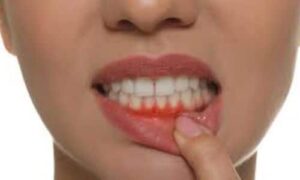 Explore the insidious nature of gum diseases and the risks associated with their silent progression. Learn how to protect your oral health.