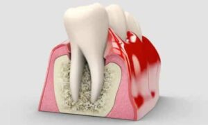 The Role of Nutrition in Preventing Gum Diseases