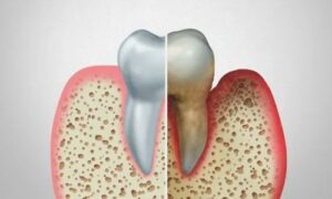 This comprehensive guide will explore essential gum disease tips for prevention and treatment, empowering you to take proactive steps towards maintaining healthy gums and a vibrant smile.