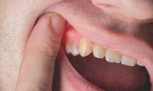 Proper gum diseases and oral hygiene care safeguard your teeth and gums and can positively affect other aspects of your body, including...