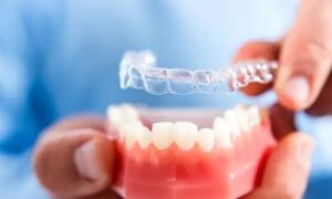 Invisalign vs Braces