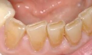 Dental cupping of front teeth is a concern for aesthetic and oral health. It refers to the development of small indentations or cup-like depressions on the surface of the front teeth,