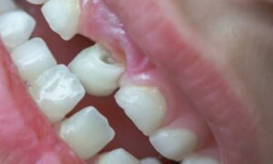 dental pothole