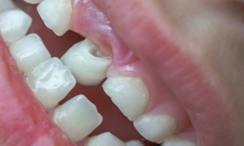 dental pothole