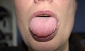 It is important to consult a healthcare provider in cases where medications contribute to dry mouth or other symptoms associated with scalloping on the tongue. Adjusting the medication regimen, either by altering dosages or switching to alternative drugs with fewer side effects, can alleviate these issues. Medications for conditions like high blood pressure or psychiatric disorders often have side effects that impact saliva production and oral health. By making appropriate changes under medical supervision, the negative impact on the tongue can be minimized, thereby reducing the occurrence of scalloping.