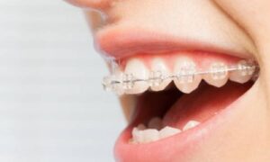 This article will explore the concept of Invisalign pressure, what it means, and how to manage it effectively.