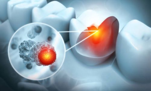 This article will explore tooth infection kills, the associated risks, and the importance of timely intervention.