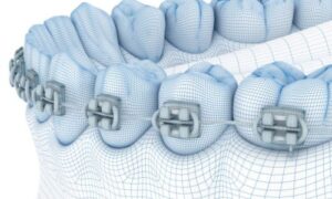 Do Braces Go on Molars?