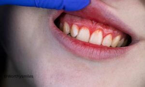 This article will explain the differences, causes, symptoms, and treatments of gingivitis vs periodontal disease.
