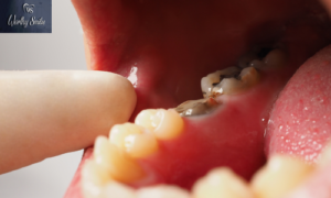 When it comes to dental health, root canals, and tooth extractions are two common procedures that can save or remove a tooth.