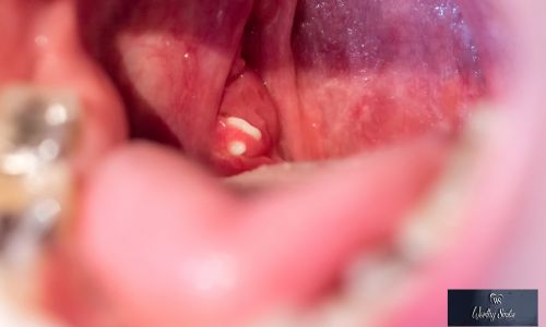 tonsil stones symptoms