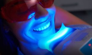Top 10 Reasons to Choose Professional Teeth Whitening.