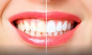 Teeth whitening treatment process