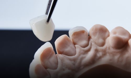Need a Dental Crown